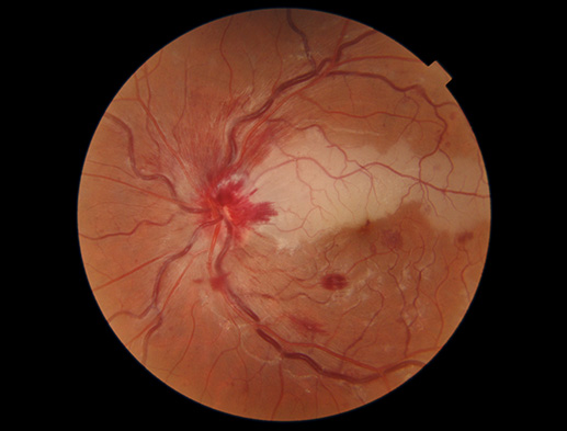 Retinal photo of a central retinal vein occlusion and branch retinal artery occlusion impairing the vision in the patient's left eye.
